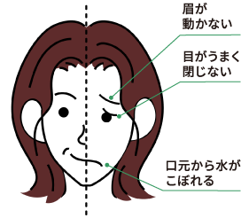 顔面神経麻痺は発症から３日以内に受診が大切なこと