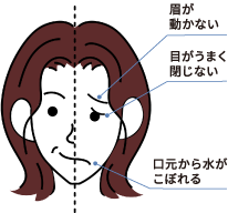 顔面神経麻痺をご存知ですか？