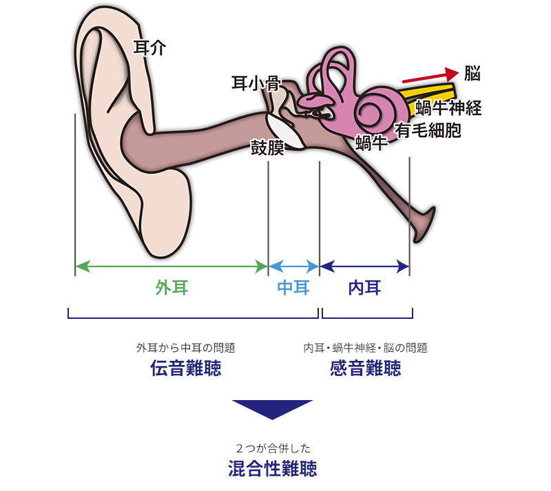 難聴の種類