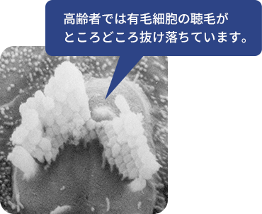 高齢者では有毛細胞の聴毛がところどころ抜け落ちています。