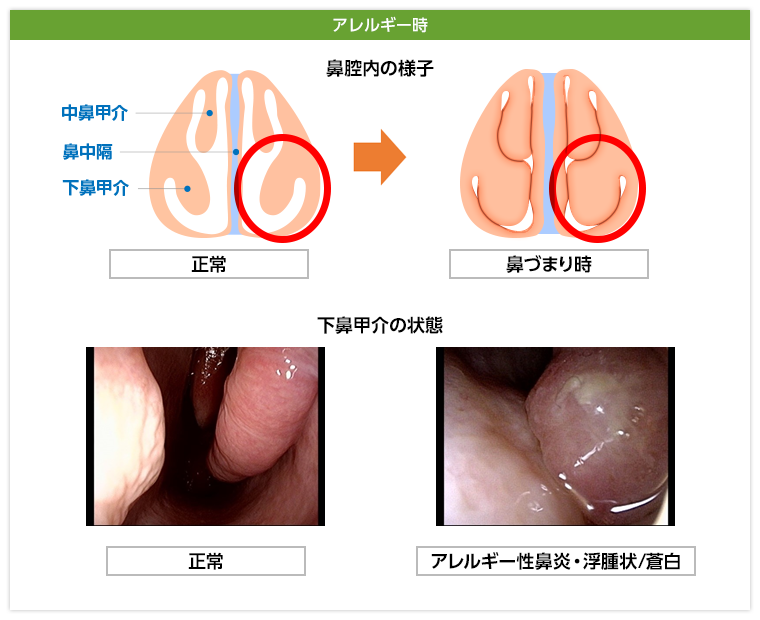 アレルギー性鼻炎（左側）