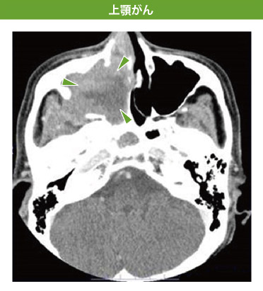 上顎がん