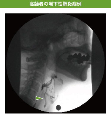 高齢者の嚥下性肺炎症例