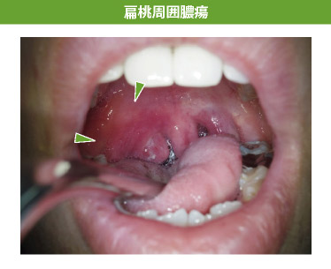 扁桃周囲膿瘍