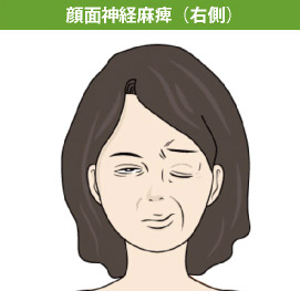 顔面神経麻痺（右側）