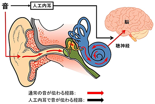 人工内耳について｜一般社団法人 日本耳鼻咽喉科頭頸部外科学会