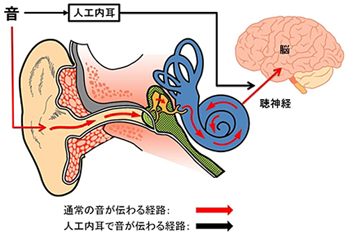 人工内耳