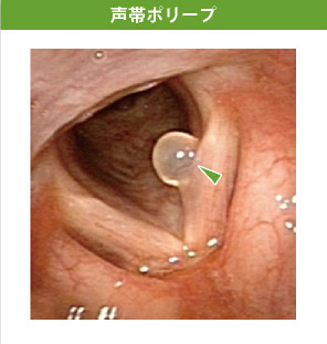 声帯ポリープ