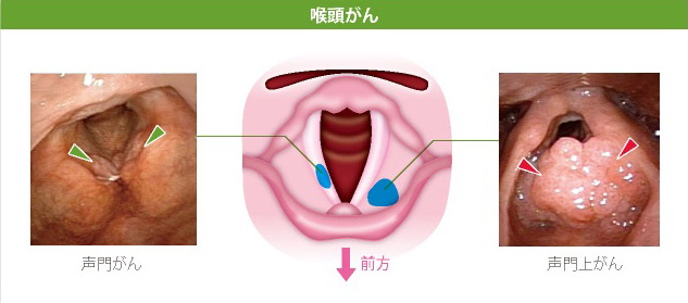 喉頭がん