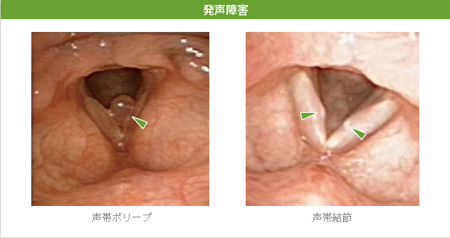 発声障害：声帯ポリープ・声帯結節