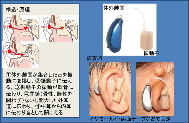 軟骨伝導補聴器