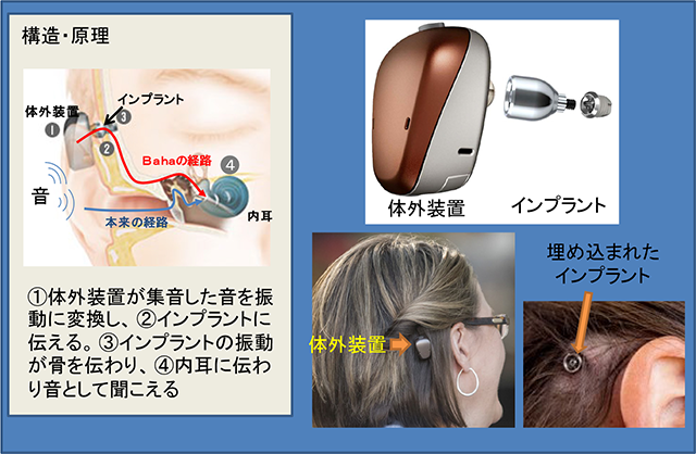骨固定型補聴器（Baha®システム）