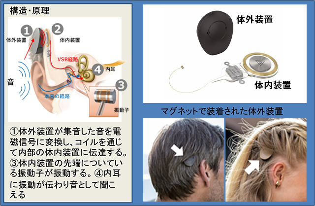 人工中耳VSB（Vibrant Soundbridge®）