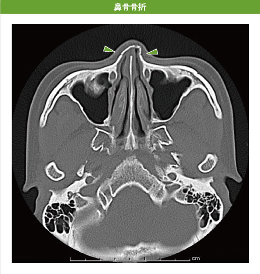 鼻骨骨折